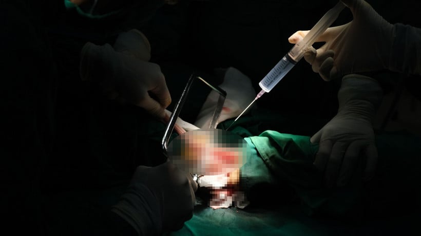 Los cirujanos tratan la pierna gangrenosa.