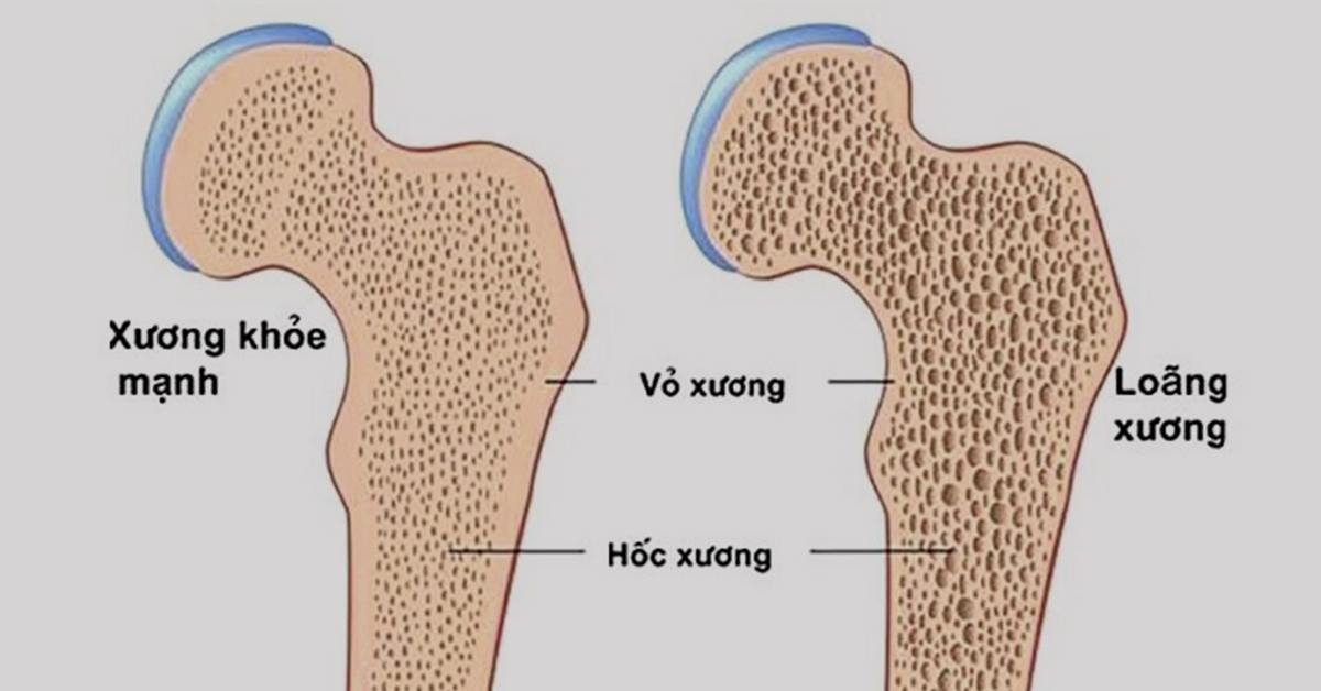 Làm gì để phòng ngừa bệnh loãng xương?