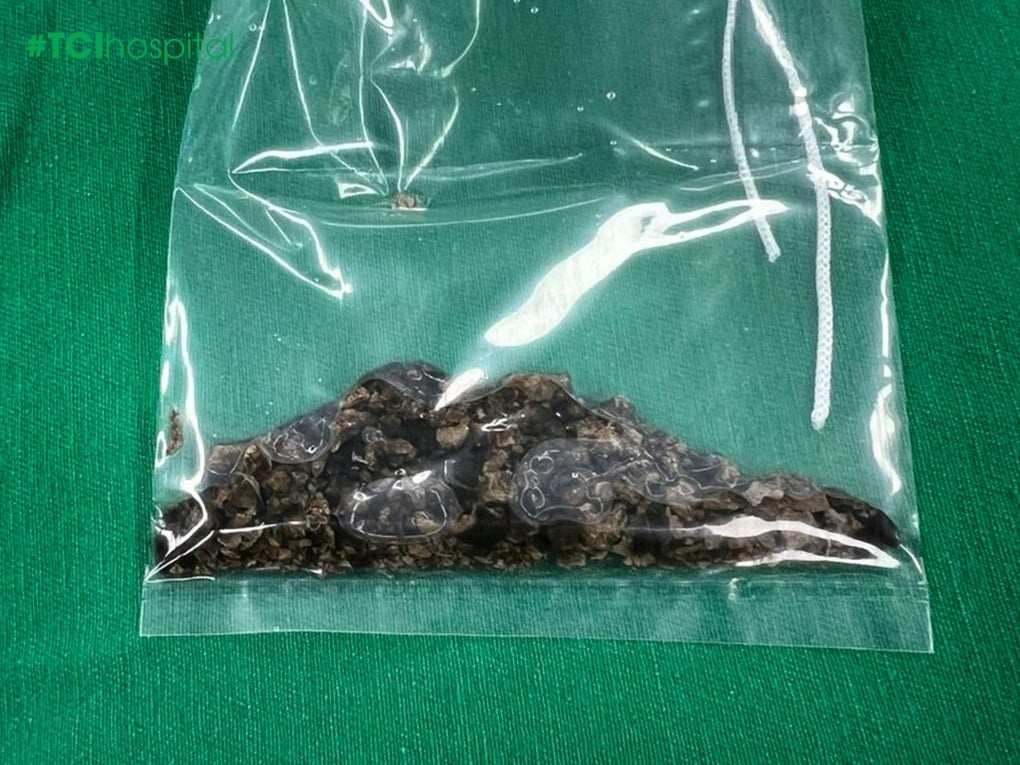 Tán sạch sỏi lâu năm bám chặt như các mảng “rỉ sét” trong bể thận - 1