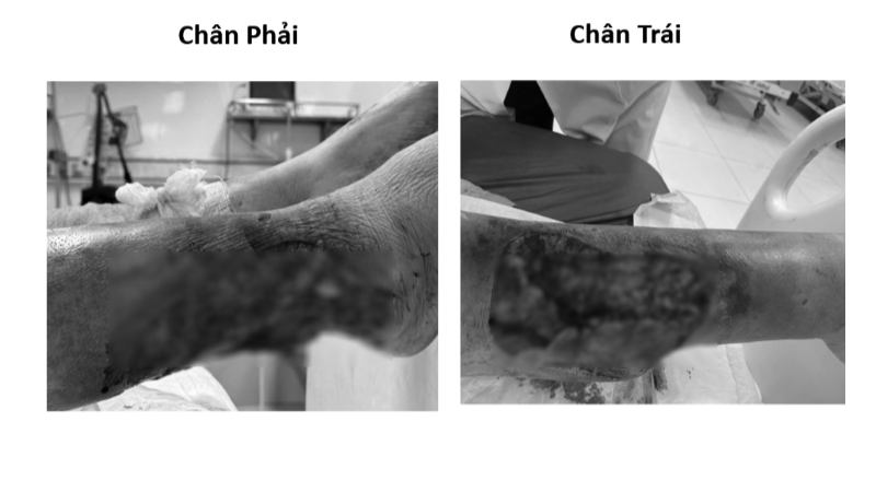 A female patient was admitted to the hospital with skin peeling injuries on both legs due to a traffic accident, the wound was at risk of necrosis. (Photo: BVCC)
