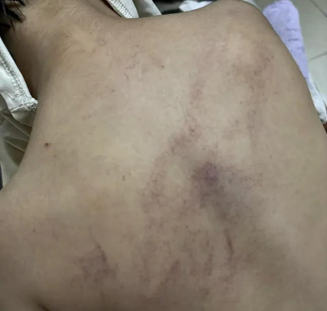 Kindergarten child's back bruised after being beaten, clip from camera leaves parents shocked photo 1