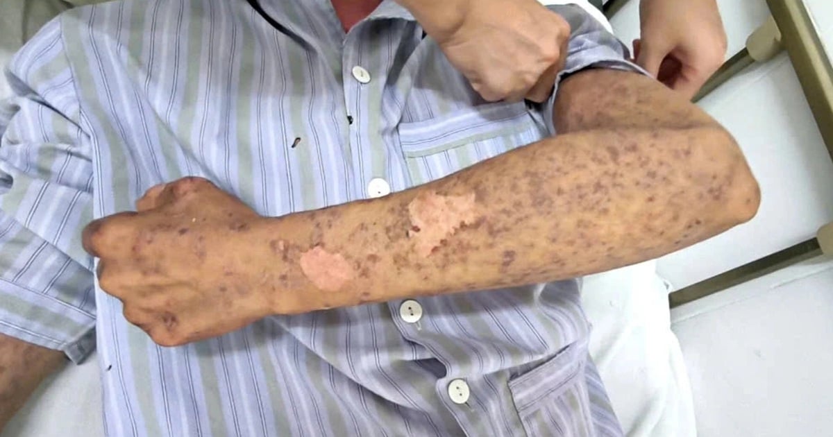 Rare: Temporary blindness, kidney failure after exposure to silicon