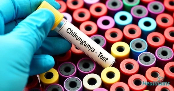 Không nên tự ý điều trị khi có dấu hiệu mắc Chikungunya