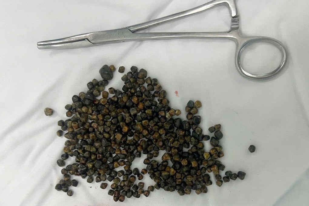 Mổ ở Mỹ thất bại, nữ Việt kiều được bác sĩ tại TPHCM lấy 481 viên sỏi mật - 1
