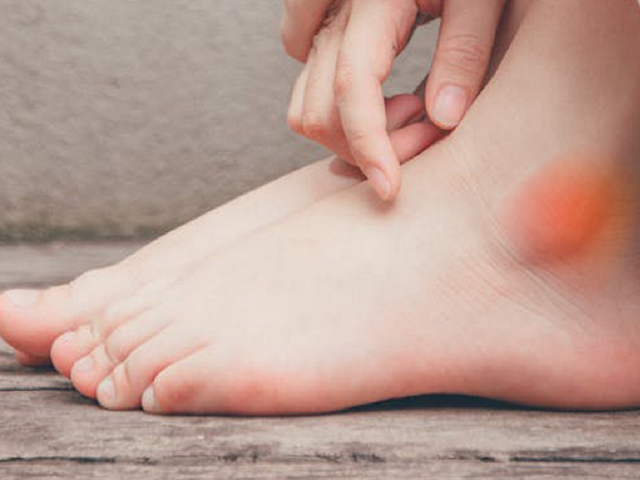 Sưng phù mắt cá chân: 4 căn bệnh nguy hiểm có thể đang mắc- Ảnh 1.