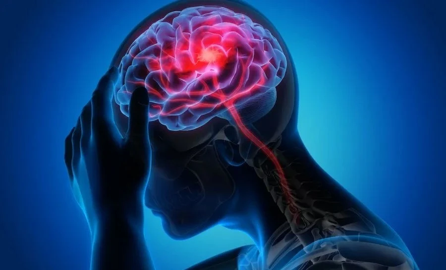 Đột quỵ ngày càng trẻ hóa