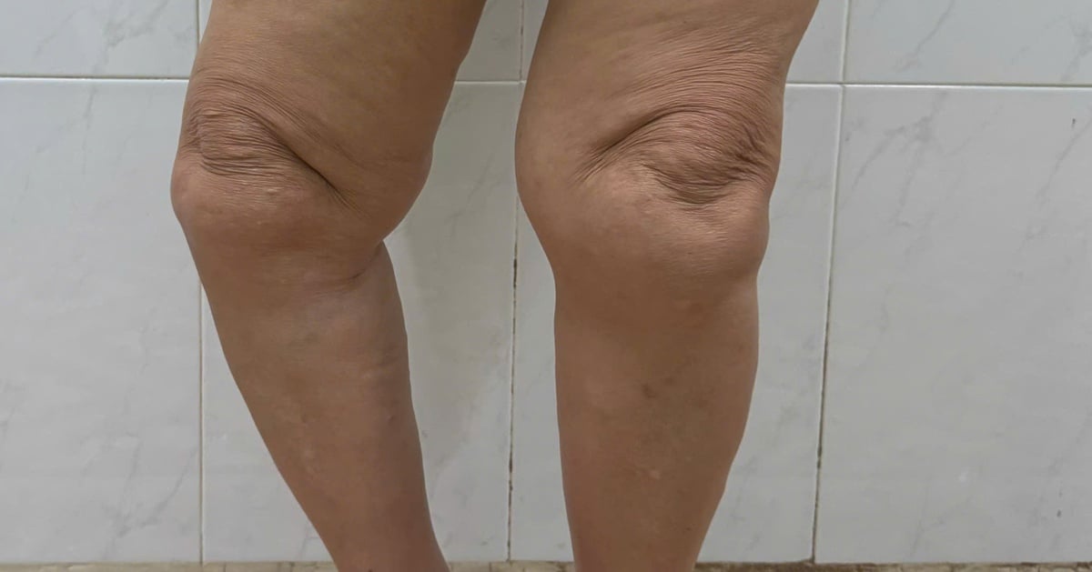 Lấy lại dáng đi cho người phụ nữ 69 tuổi nhờ kỹ thuật thay khớp gối bản lề