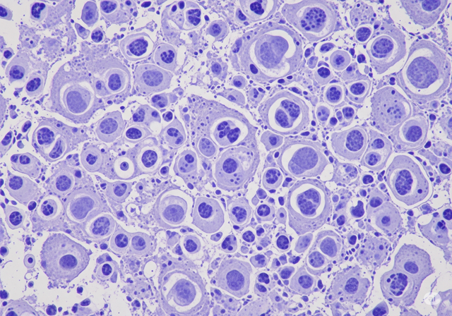 Ricerca: Alla ricerca di trattamenti efficaci per il cancro al fegato, ai polmoni e allo stomaco - Immagine 1.