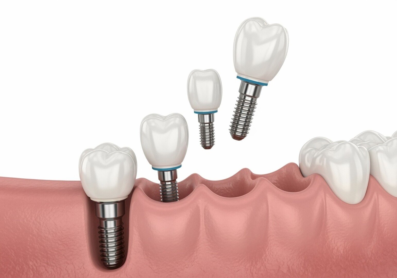 Show,me,a,gum,line,with,a,dental,implant,in