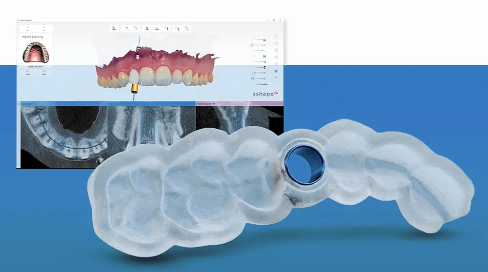 DSG デジタルポジショニングテクノロジーの応用は、今日の歯科に安全性をもたらすテクノロジーです。