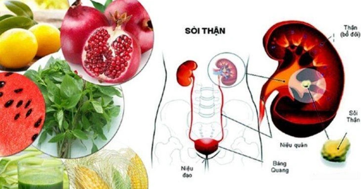 Biện pháp đơn giản hàng đầu giúp đẩy lùi sỏi thận