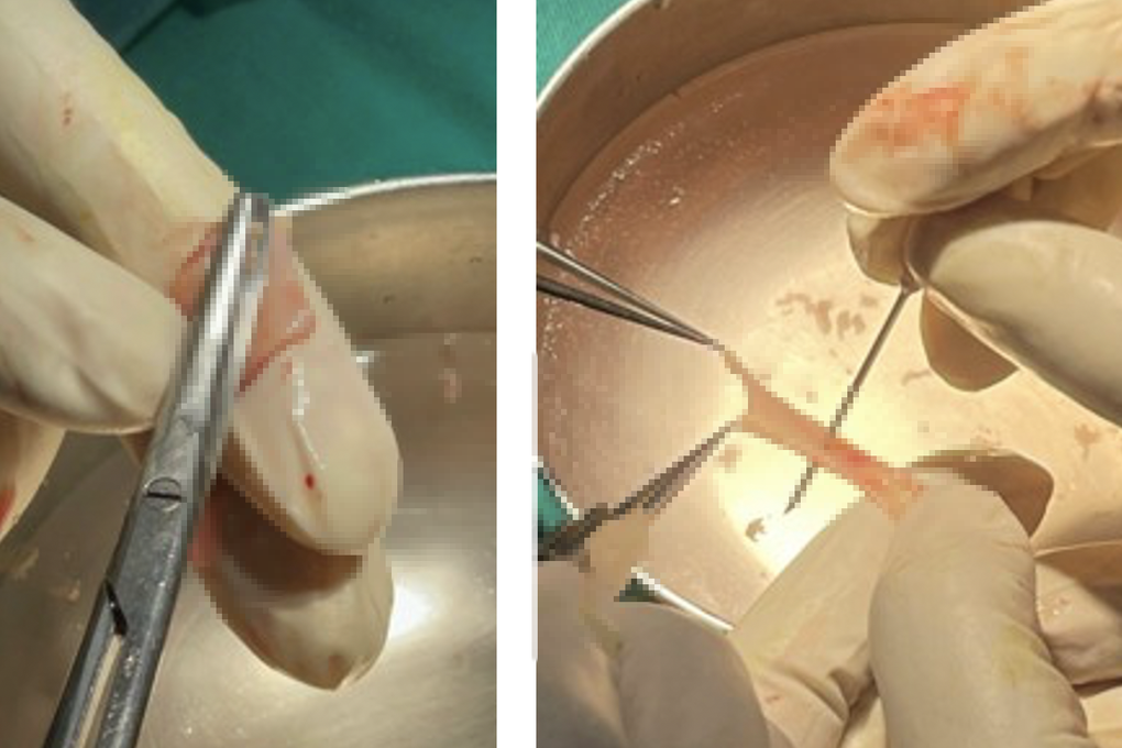 TPHCM: Bác sĩ dùng da trong miệng để... cứu đường tiểu chàng trai 29 tuổi - 2