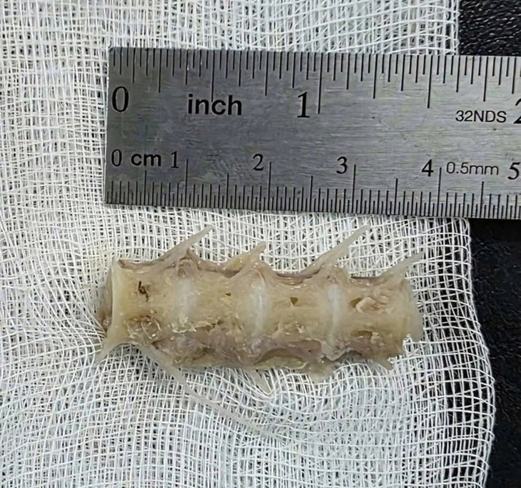 Hóc đoạn xương sống cá 4cm trong cổ, cụ ông 99 tuổi nguy kịch - Ảnh 1.