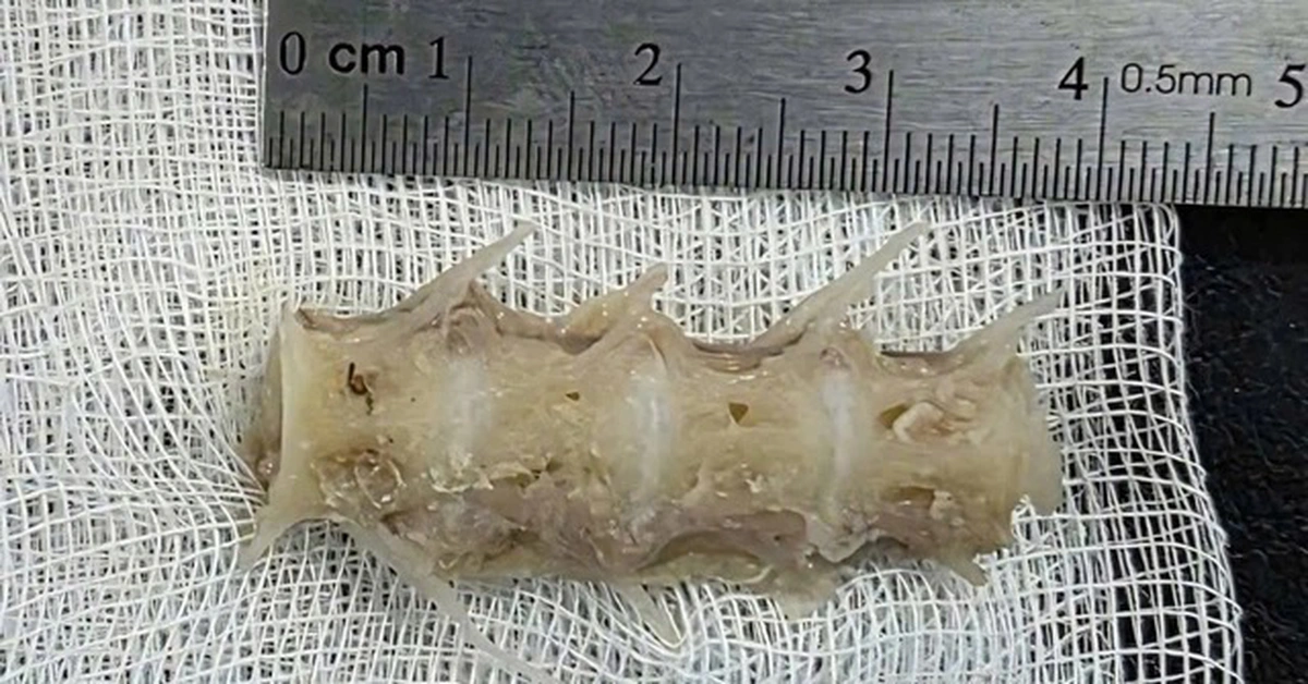 Hóc đoạn xương sống cá 4cm trong cổ, cụ ông 99 tuổi nguy kịch