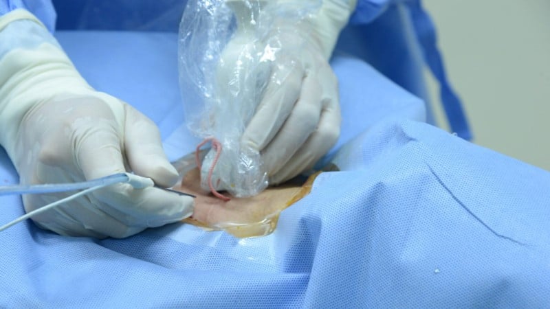 Theo các bác sĩ Bệnh viện Nội tiết Trung ương, kỹ thuật đốt sóng cao tần là một giải pháp đột phá, mang lại hiệu quả cao, an toàn và ít xâm lấn.