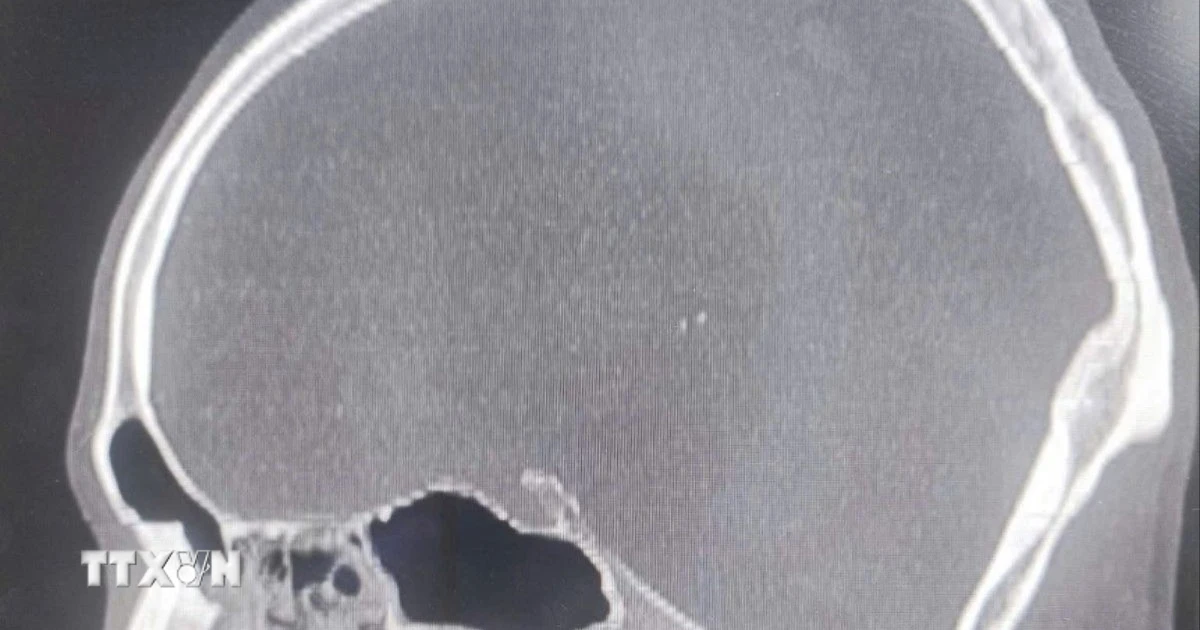 Thanh Hoa: Successfully treated patient with steel drill piercing through nasal cavity