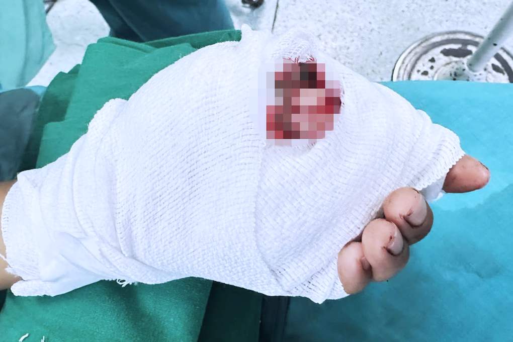 Đi cắt mì phụ giúp gia đình, bé trai 12 tuổi bị đứt hai ngón tay thương tâm - 1