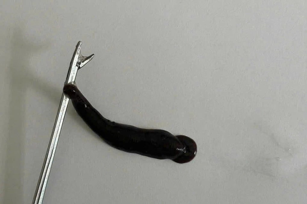 Con đỉa lớn nằm trong mũi bé trai 14 tuổi - 1