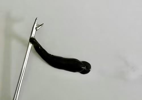 Đỉa suối dài 4cm trong mũi thiếu niên 14 tuổi -0