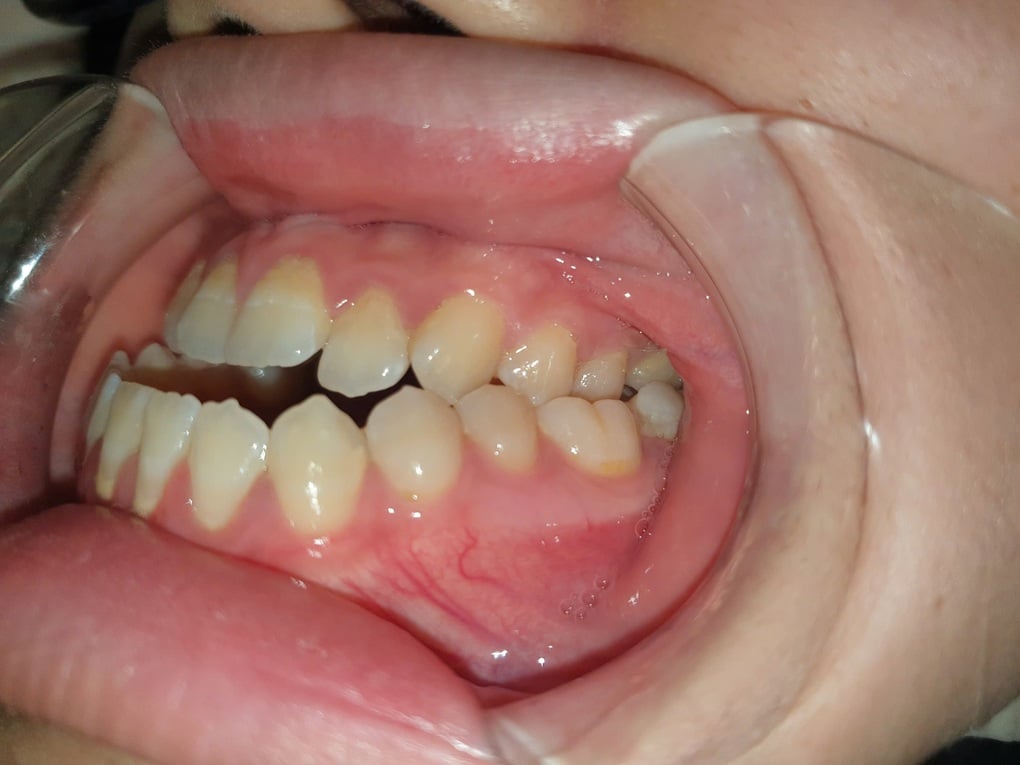 Làm sao xử lý gương mặt lưỡi cày? - 2