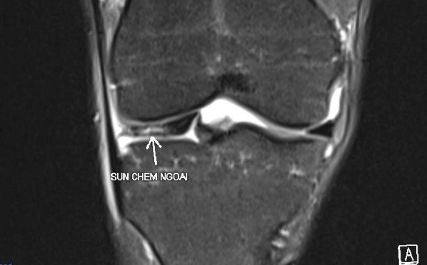 chup-mri-cho-thay-ton-thuong-rach-sun-chem.jpg