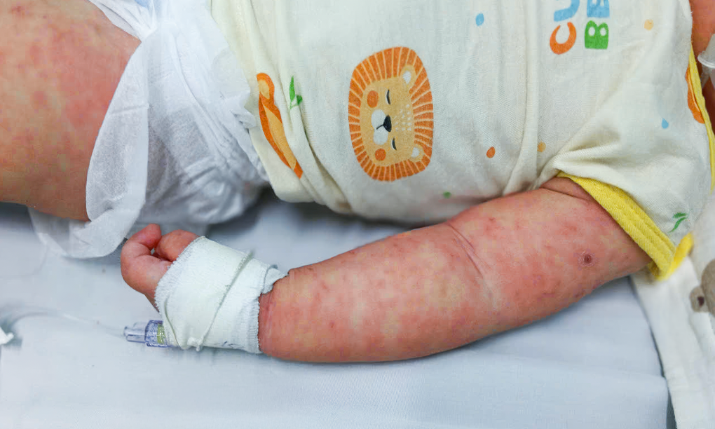 VNVC announced that it has additional vaccines to prevent 4 diseases: measles, mumps, rubella, chickenpox - 3
