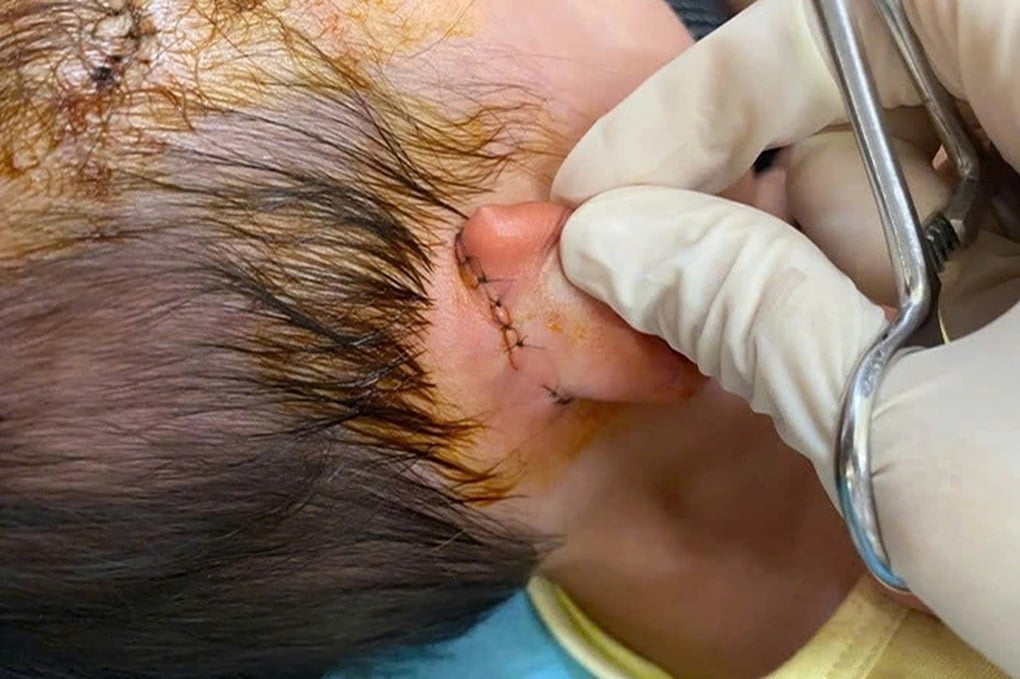 Bé gái 19 tháng tuổi bị chó nhà hàng xóm cắn liên tục vào vùng đầu mặt - 1