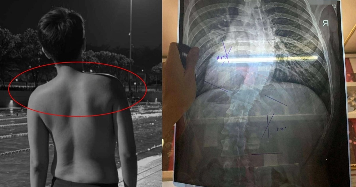 Dân văn phòng vai lệch nặng, cột sống cong vẹo trước tuổi 30