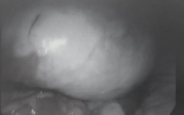 Đau bụng âm ỉ, nhập viện bác sĩ phát hiện khối u buồng trứng lớn - Ảnh 1.