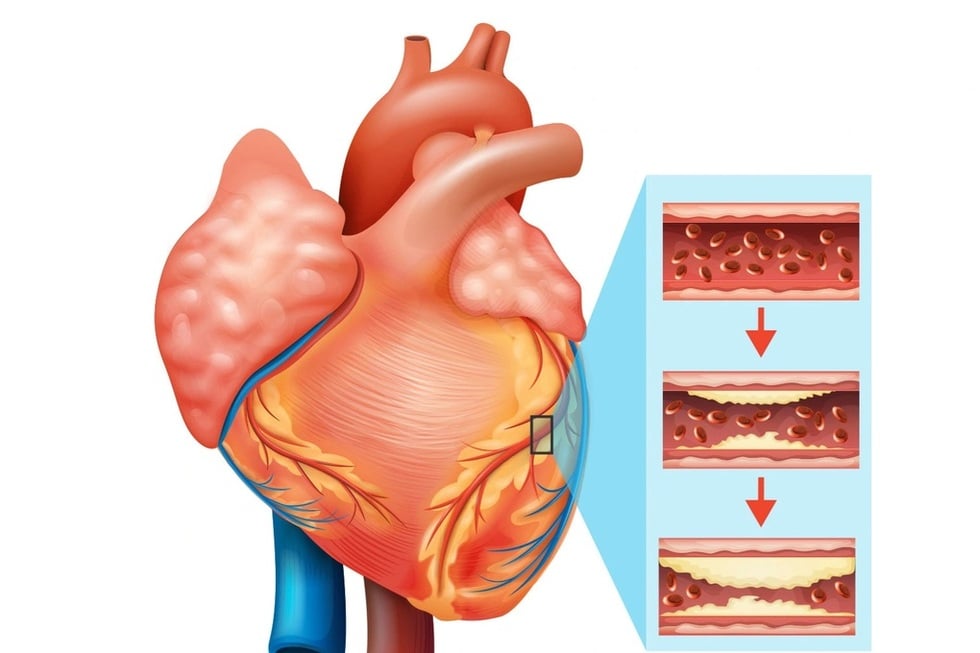 Bệnh mạch vành - mối nguy thầm lặng với trái tim - 6