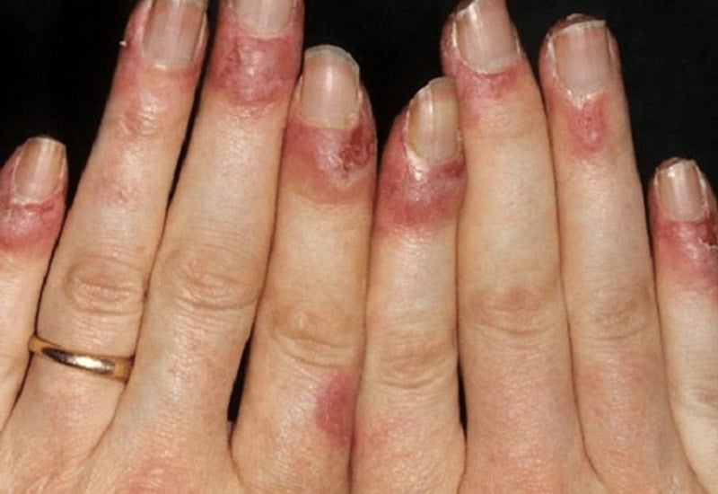 វិធីព្យាបាលជំងឺ chilblains នៅលើដៃ និងជើងនៅផ្ទះក្នុងរដូវរងា - រូបថតទី 1។ Cách chữa cước tay chân mùa đông tại nhà- Ảnh 1.
