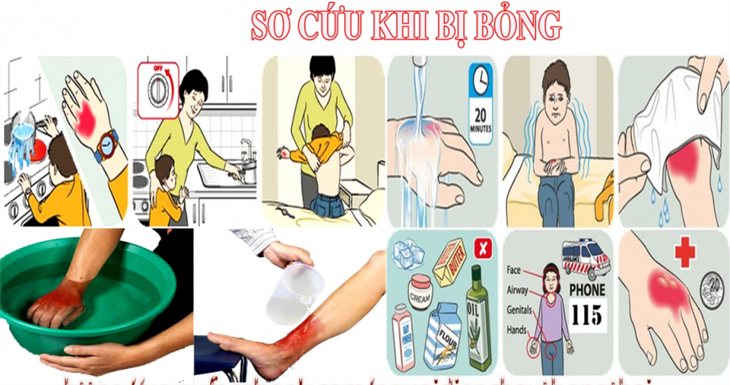 آیا باید روی سوختگی یخ گذاشت یا خمیردندان؟ - تصویر ۱. bỏng - Ảnh 1.