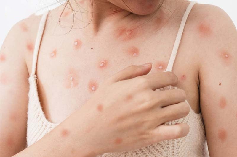 Warning: Chickenpox in adults can cause dangerous complications - Image 1.
