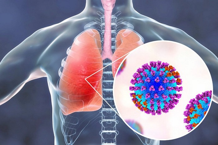 Chăm sóc bệnh nhân viêm phổi do virus- Ảnh 1.