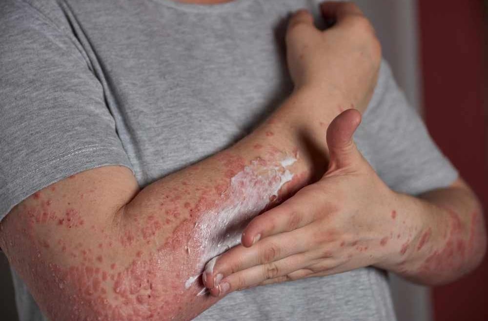 Viêm da dị ứng kiêng gì?- Ảnh 1.