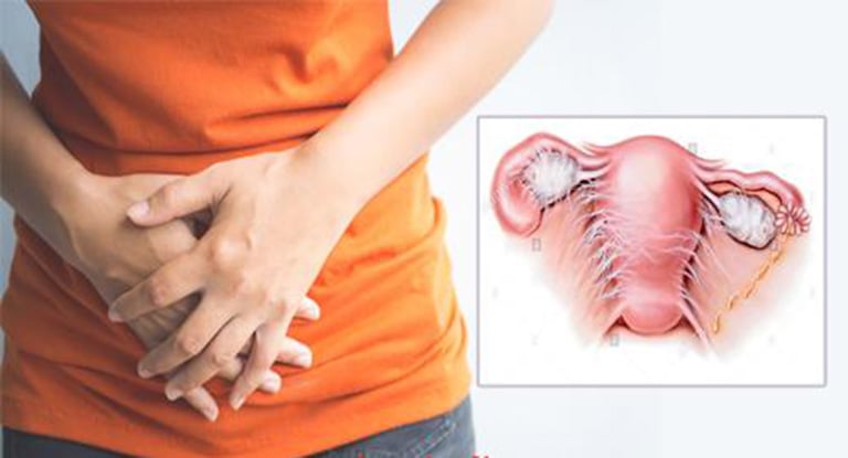 Đang viêm phần phụ có nên sinh hoạt tình dục?- Ảnh 1.