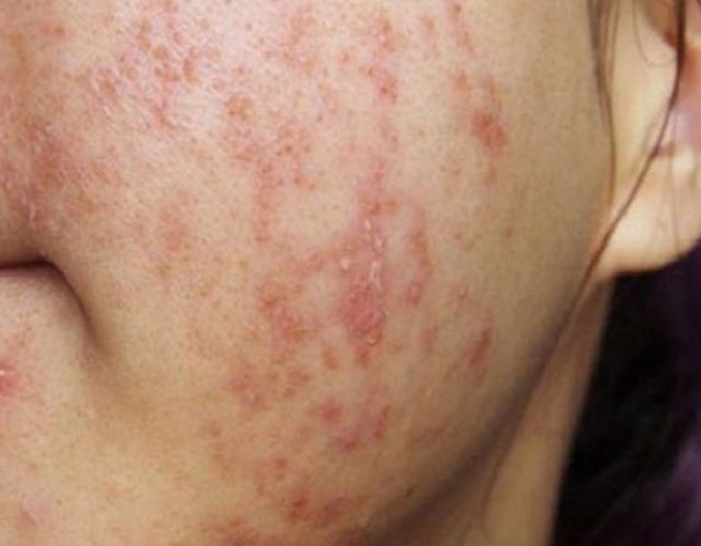 Bác sĩ da liễu cảnh báo về trào lưu sử dụng và 'đào thải corticoid' trên mạng - Ảnh 1.