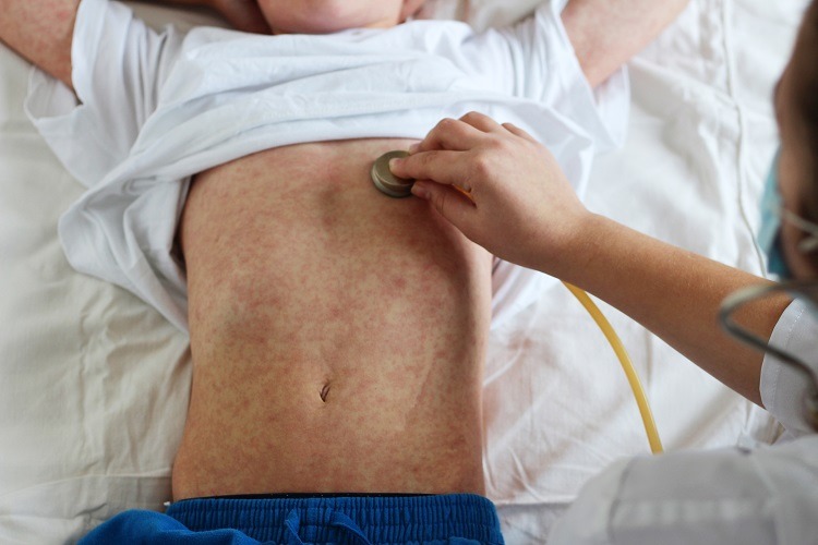 Come prendersi cura del morbillo, trattarlo e prevenirlo | Hapacol