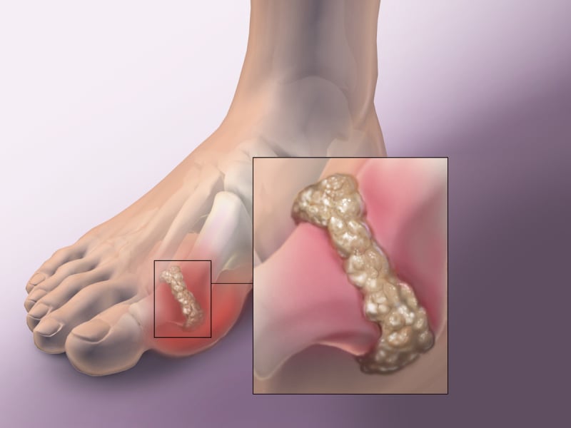 Người bệnh gout khổ sở với tiệc tùng cuối năm- Ảnh 1.