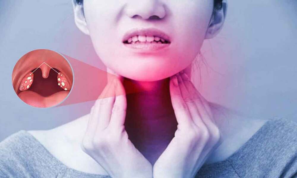Viêm amidan tái phát có nên cắt không?- Ảnh 2.