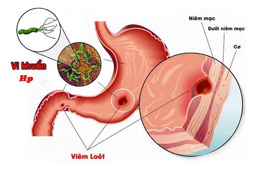 Cách dùng gừng giảm đau họng khi thời tiết thay đổi- Ảnh 2.