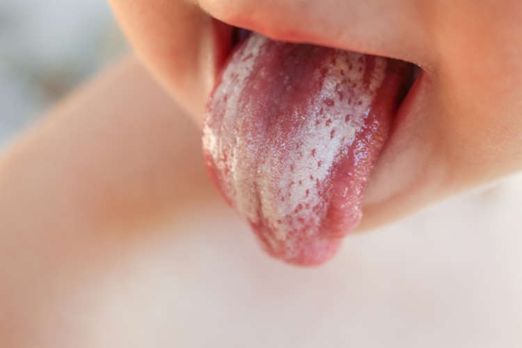 Nấm miệng có lây không?- Ảnh 2.