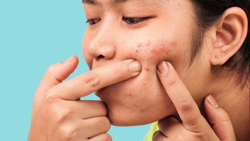 6 cattive abitudini che causano l'acne - Immagine 1.