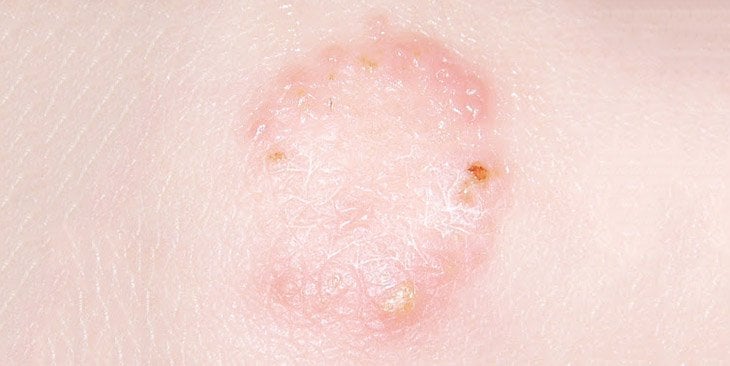 Cảnh giác nấm da lây từ chó, mèo- Ảnh 2.