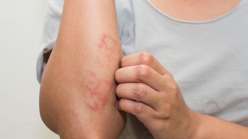 I segreti per controllare e prevenire efficacemente l'eczema - Immagine 2. Bí quyết kiểm soát và phòng ngừa eczema hiệu quả- Ảnh 2.
