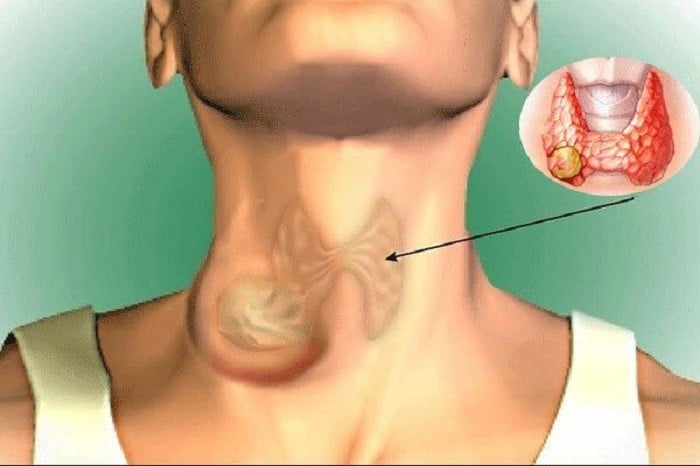 Nam giới mắc u tuyến giáp có nguy hiểm không?- Ảnh 1.