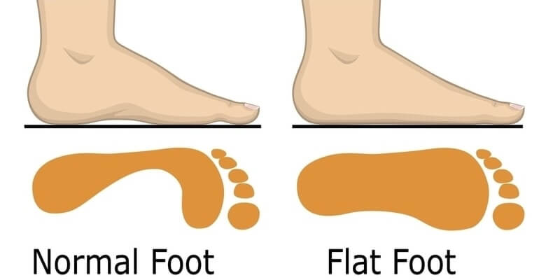 Bàn chân bẹt ở trẻ em có cần điều trị không?- Ảnh 2.