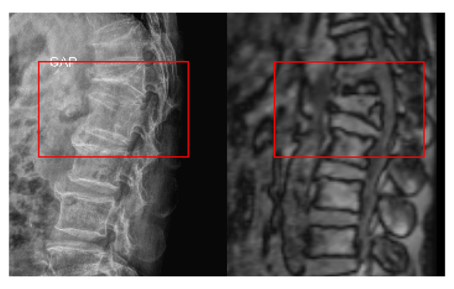 Thoát cảnh ngồi xe lăn sau 3 ngày phẫu thuật cột sống - Ảnh 1.