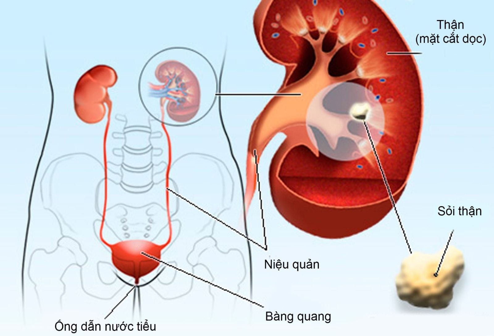 약물 없이 신장 결석을 예방하는 방법 - 이미지 1. Cách phòng ngừa sỏi thận không dùng thuốc- Ảnh 1.