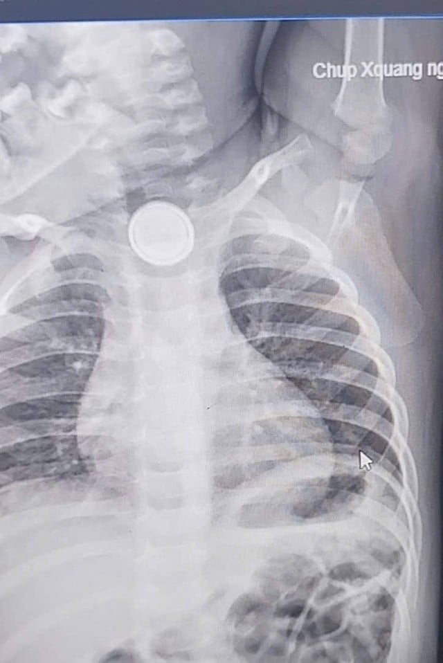 Un bambino di due anni riporta gravi ustioni esofagee dopo aver ingerito una batteria a bottone - Foto 1. Nuốt pin cúc áo, bé 2 tuổi bỏng nặng thực quản- Ảnh 1.